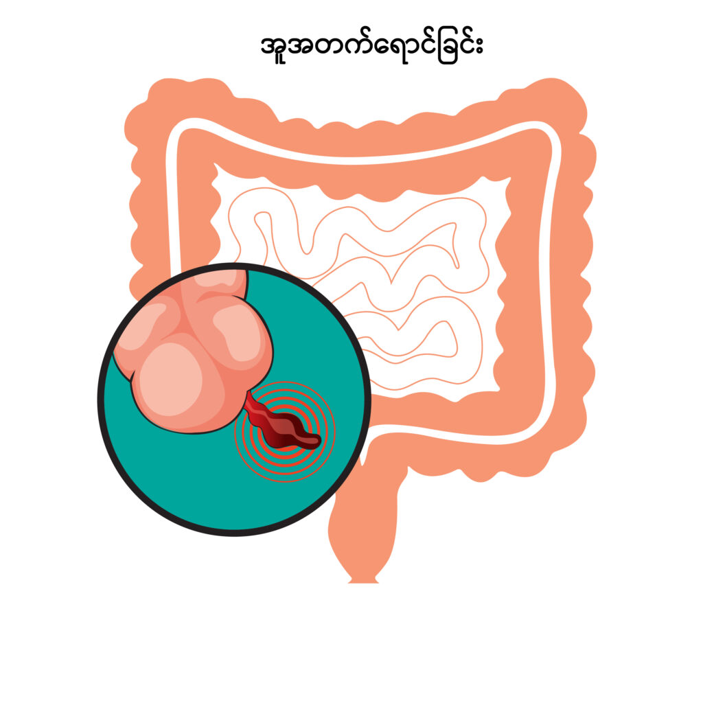 Acute Appendicitis