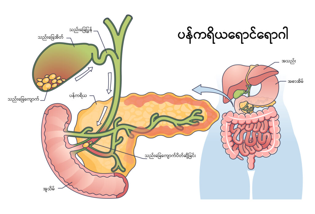 Acute Pancreatitis 