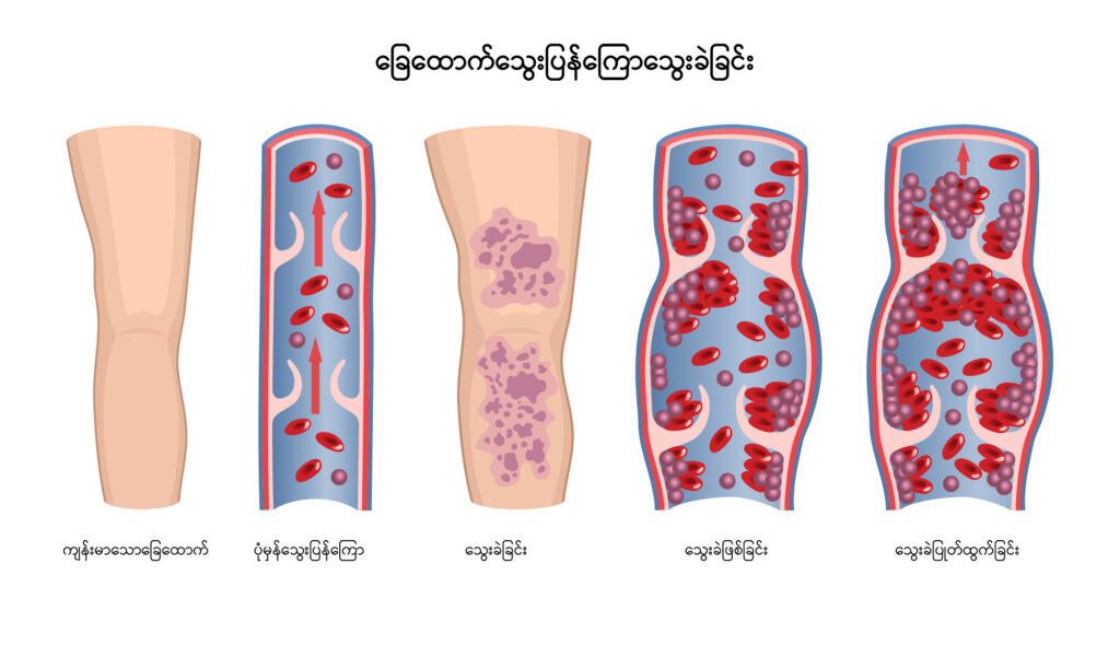 Deep Vein Thrombosis IMG 1