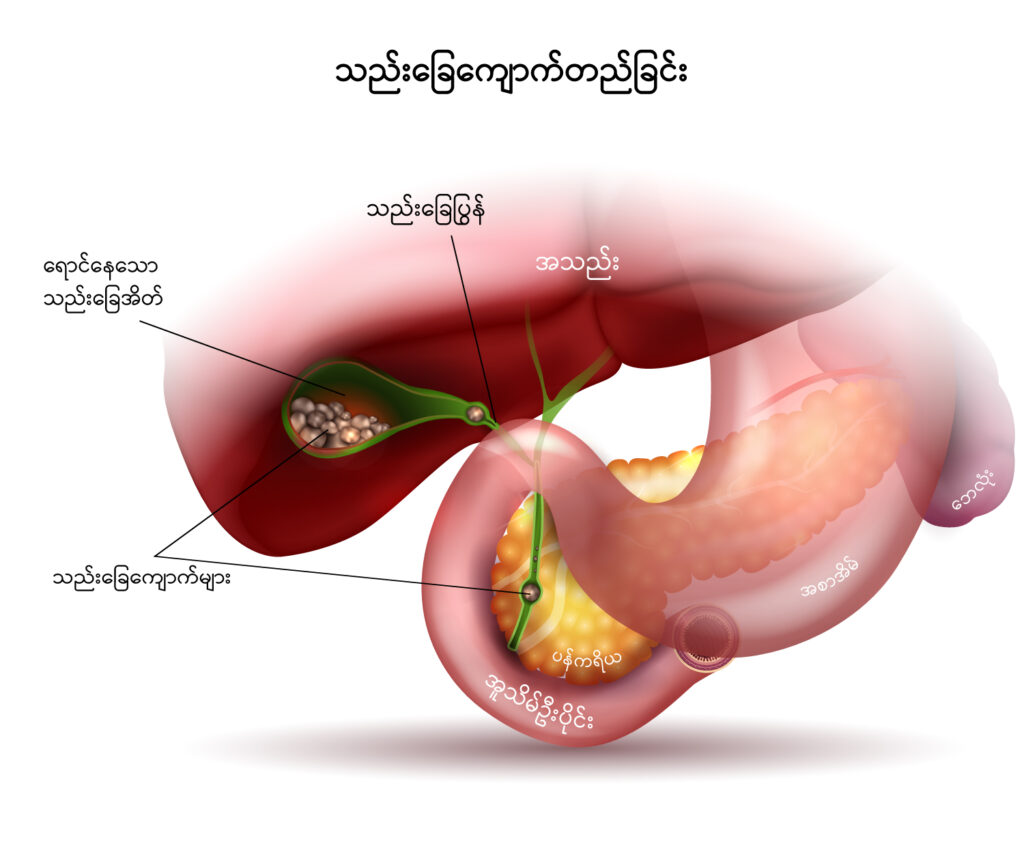 Gallstone disease IMG 