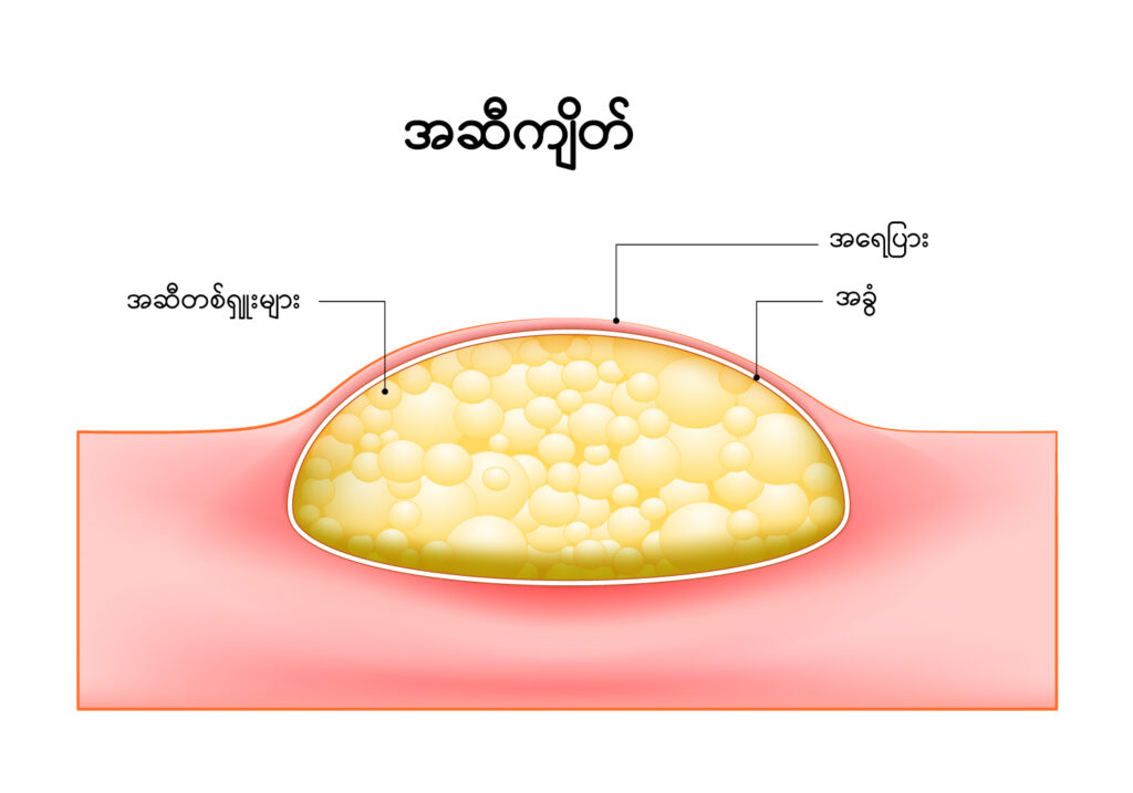 Lipoma IMG