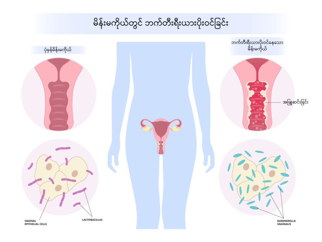 Bacterial Vaginosis IMG