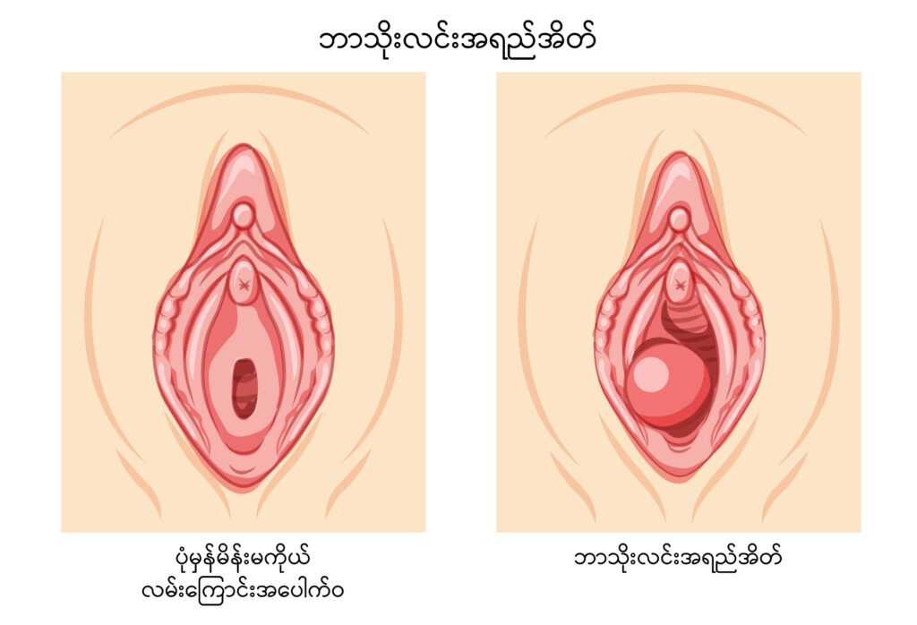 Bartholin’s cyst IMG