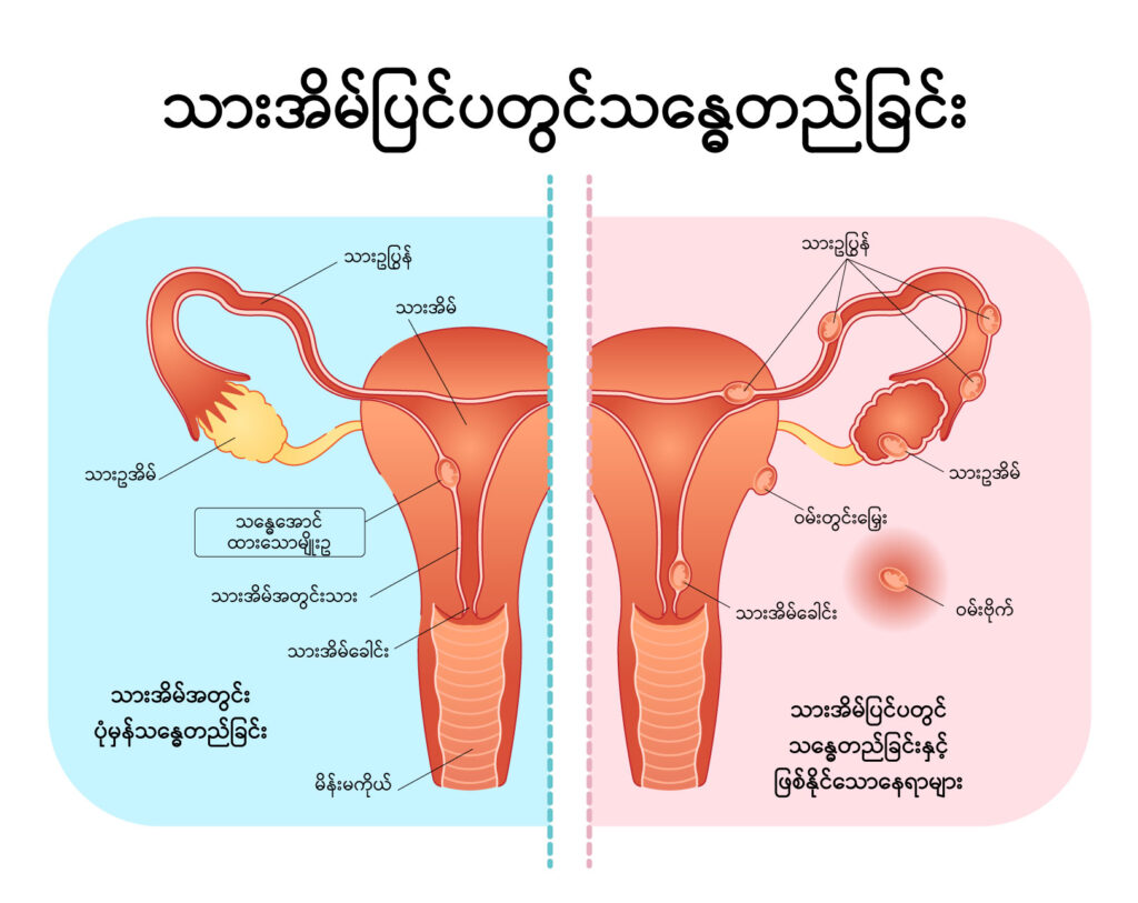 Ectopic Pregnancy