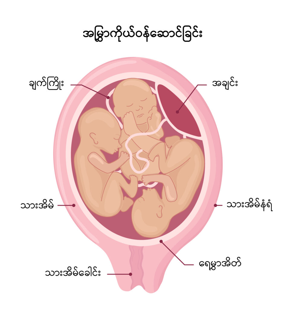 Multiple Pregnancy IMG 1