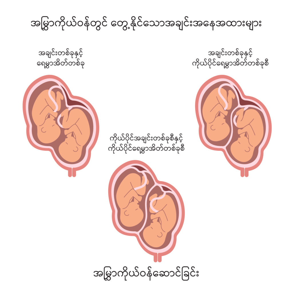 Multiple Pregnancy IMG 2