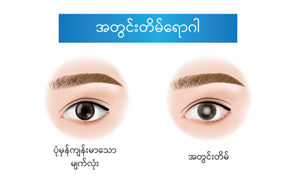 Cataract IMG 1