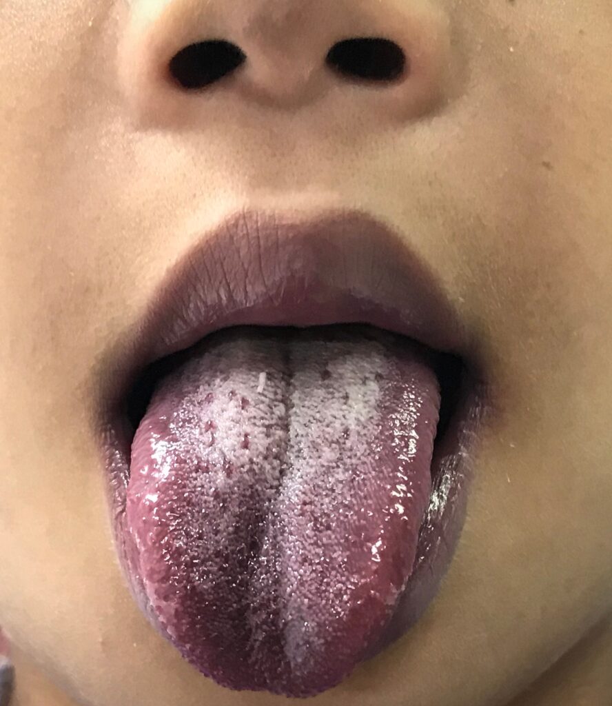 Methaemoglobinaemia IMG