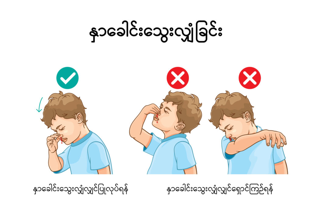 Epistaxis IMG
