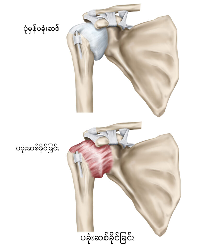 Frozen Shoulder IMG