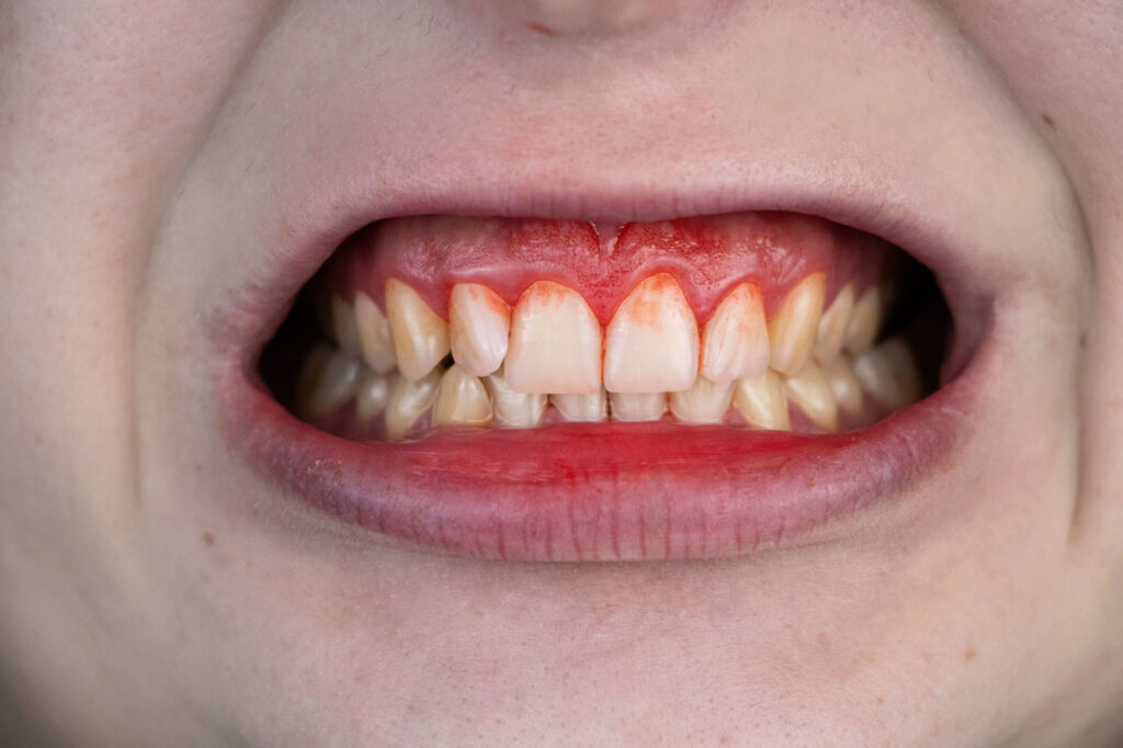 Gum Bleeding IMG