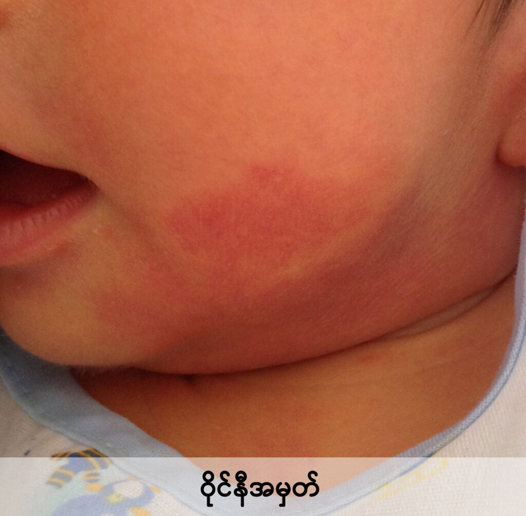birthmarks IMG 1