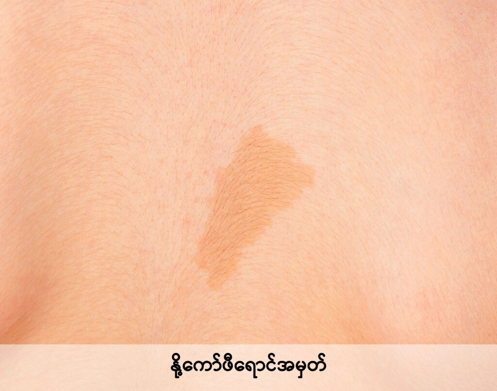 birthmarks IMG 2