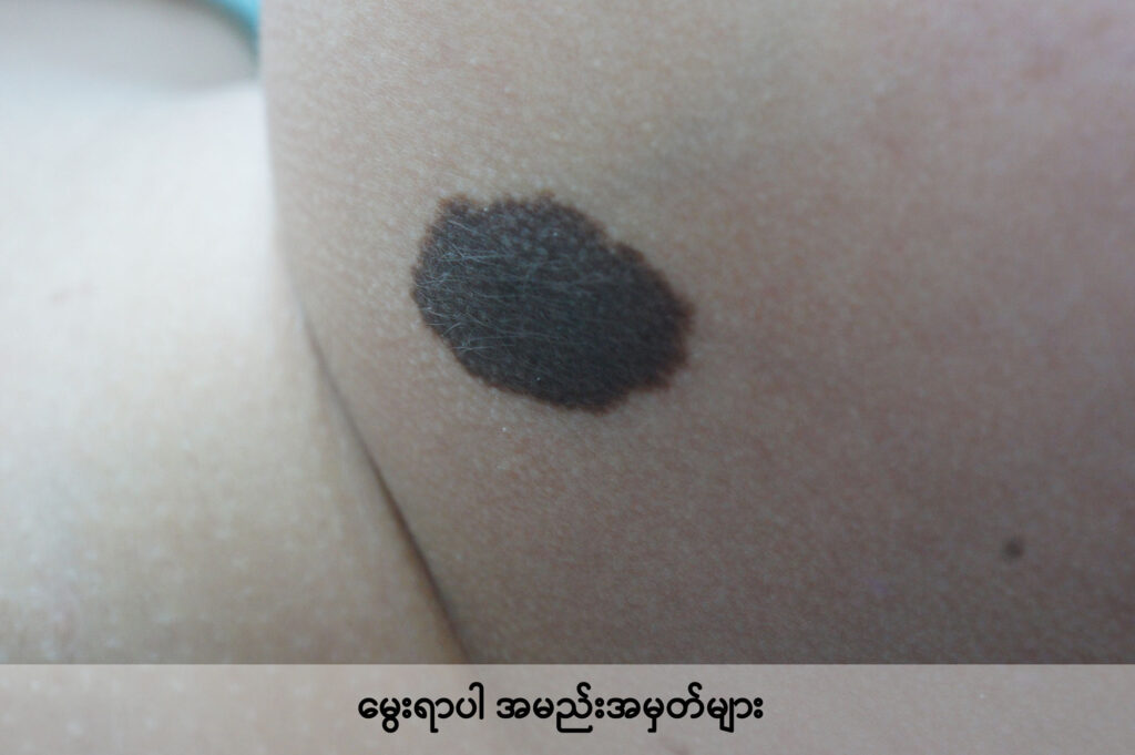 birthmarks IMG 4