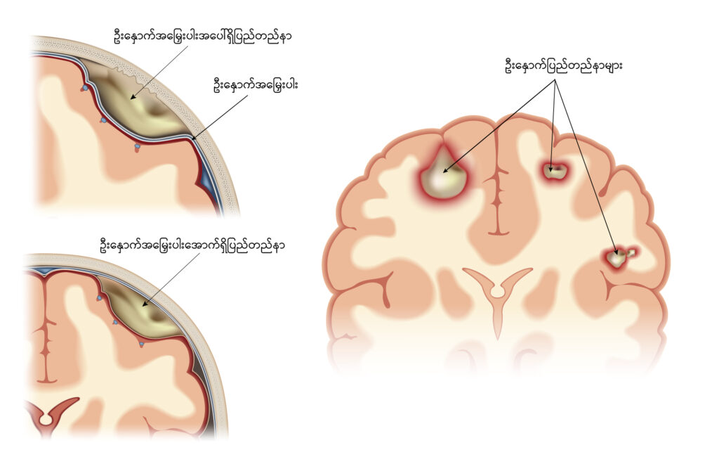 Brain Abscess IMG 1