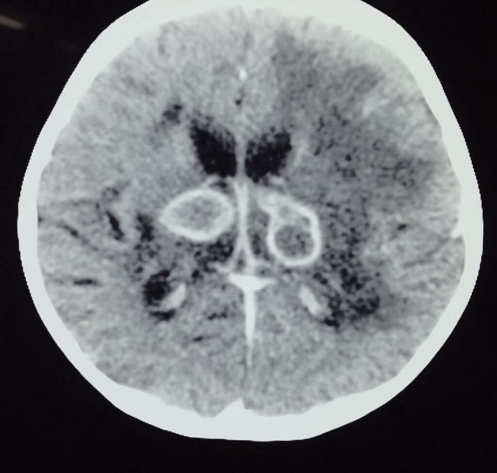 Brain Abscess IMG 2