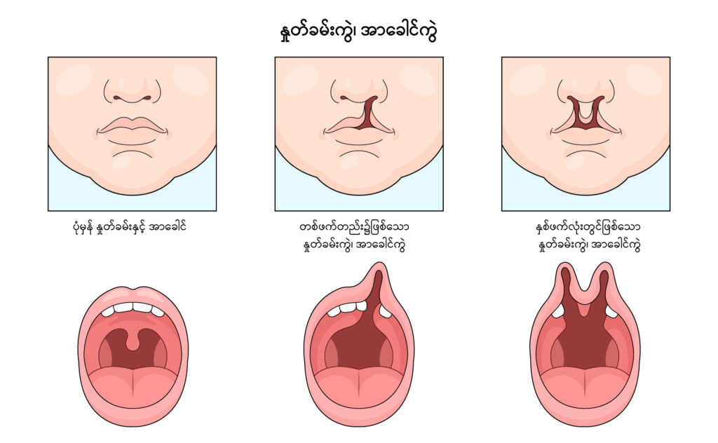 Cleft Lip and Palate IMG