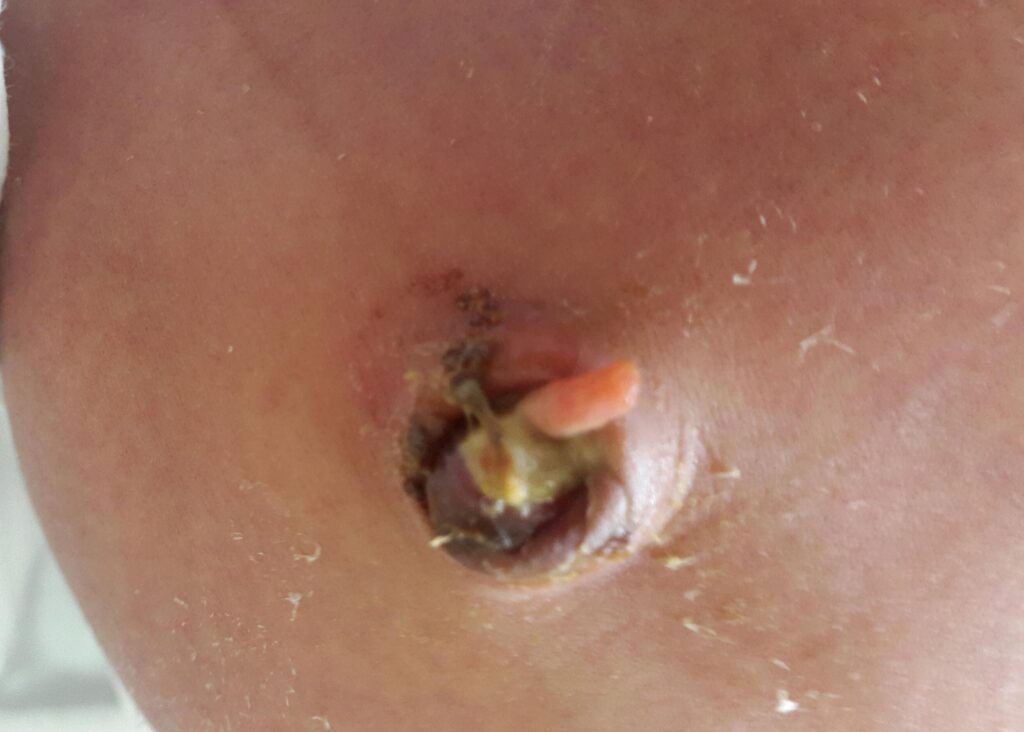 Common Umbilical Disorders in Children IMG 2
