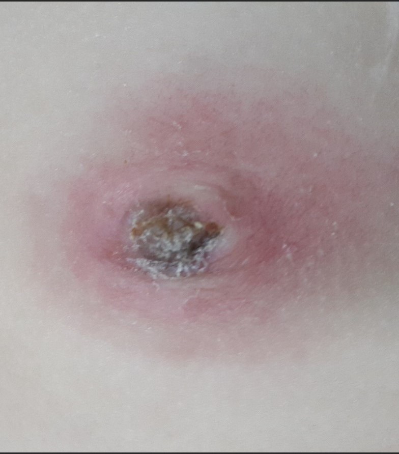 Common Umbilical Disorders in Children IMG 4