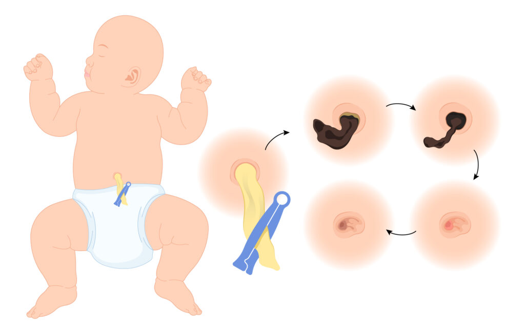 Common Umbilical Disorders in Children IMG 1