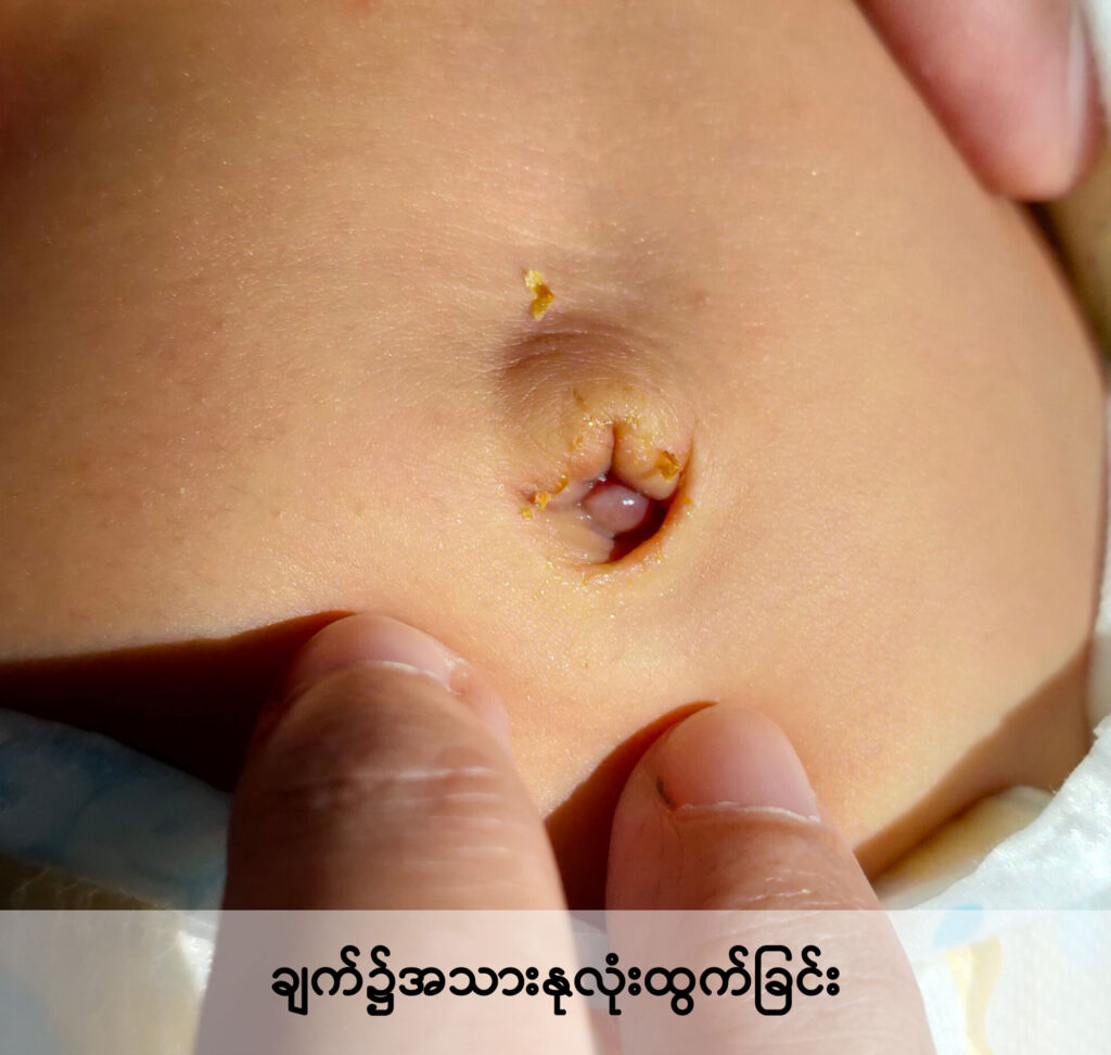 Common Umbilical Disorders in Children IMG 3