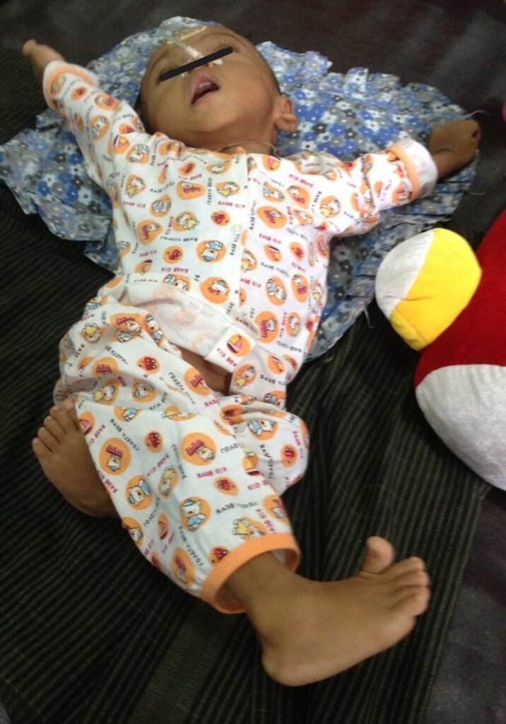 Cerebral Palsy IMG
