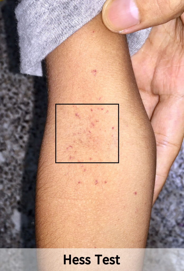 Dengue Fever In Children IMG 1