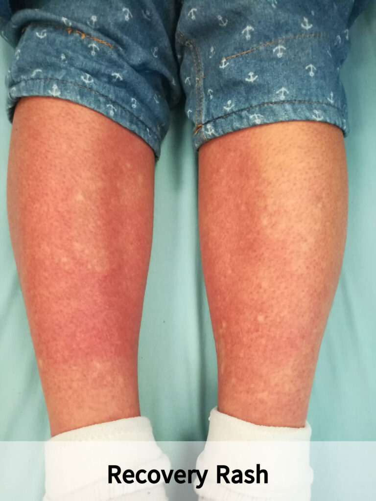 Dengue Fever In Children IMG 1