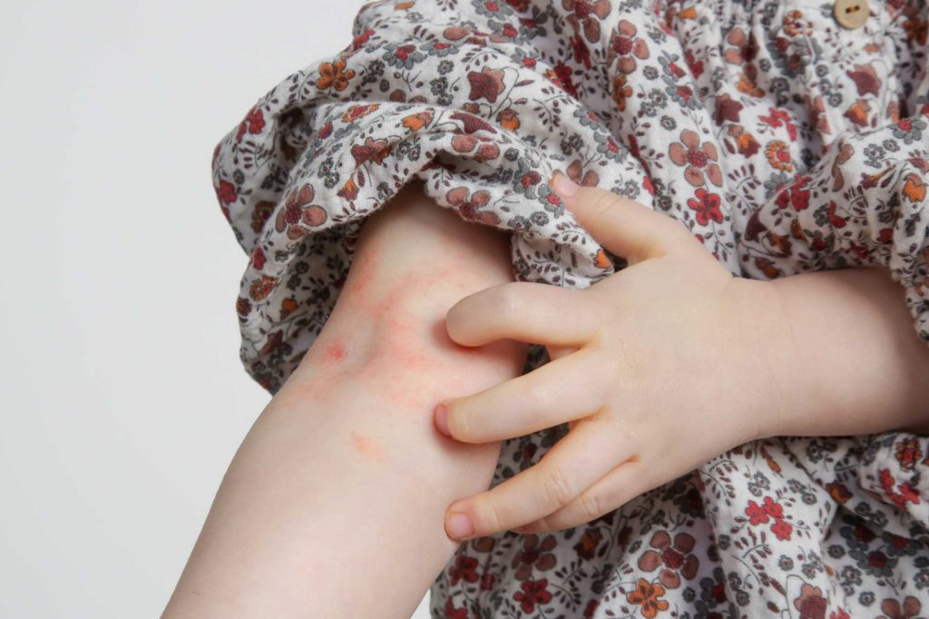 eczema IMG 2