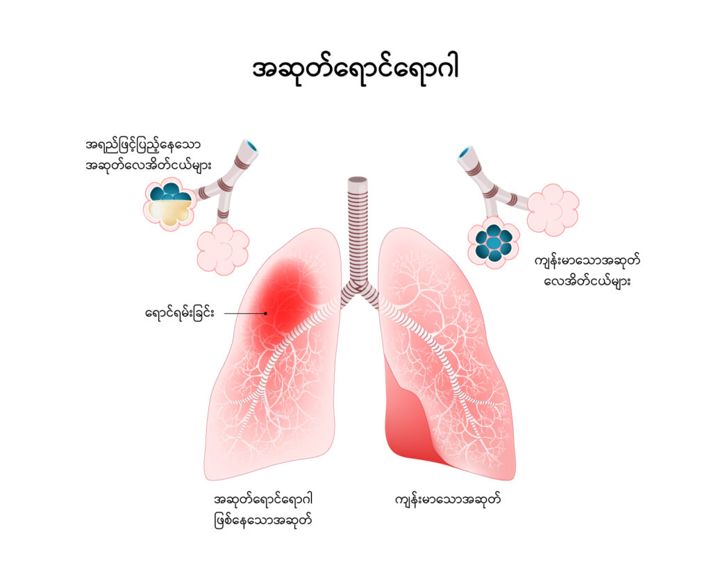 Pneumonia img1