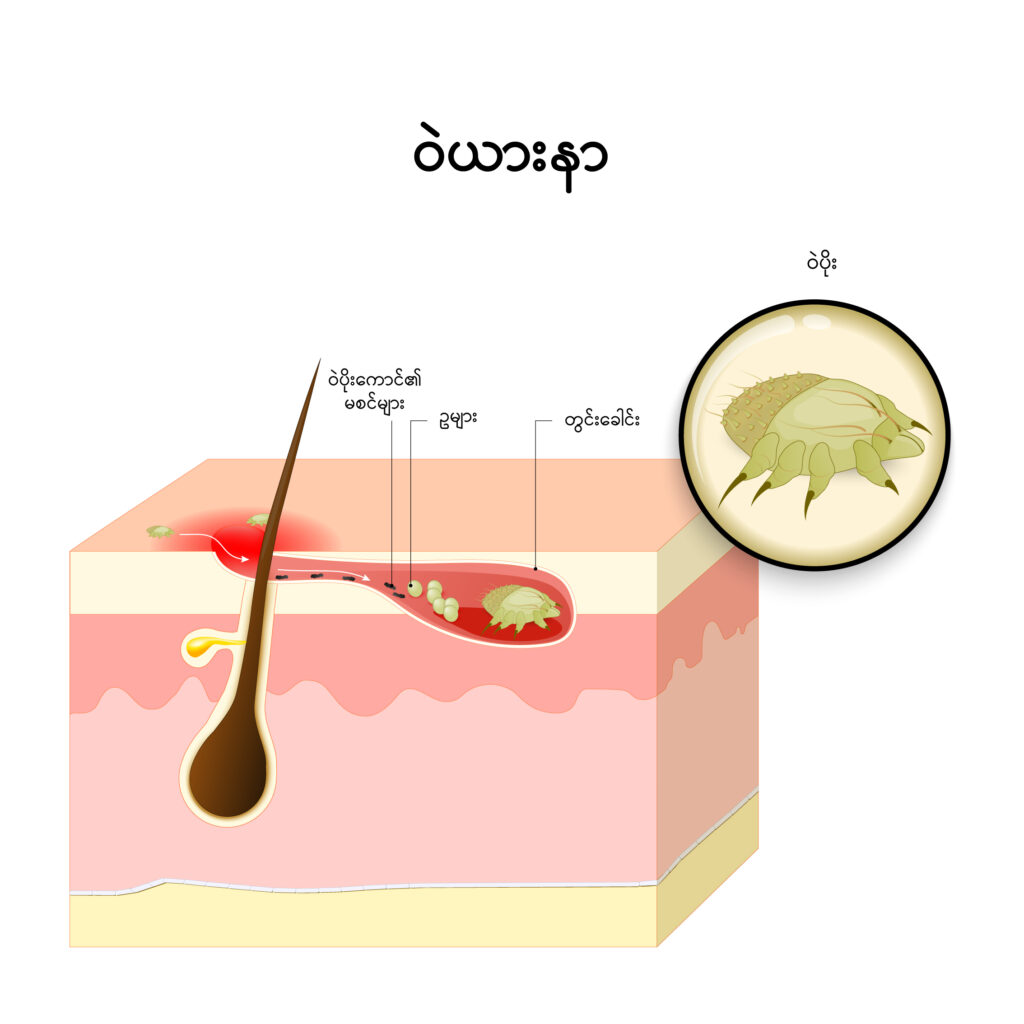 Scabies img1