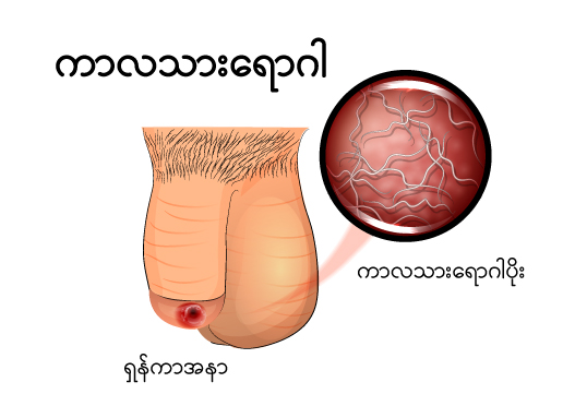 syphilisp img1