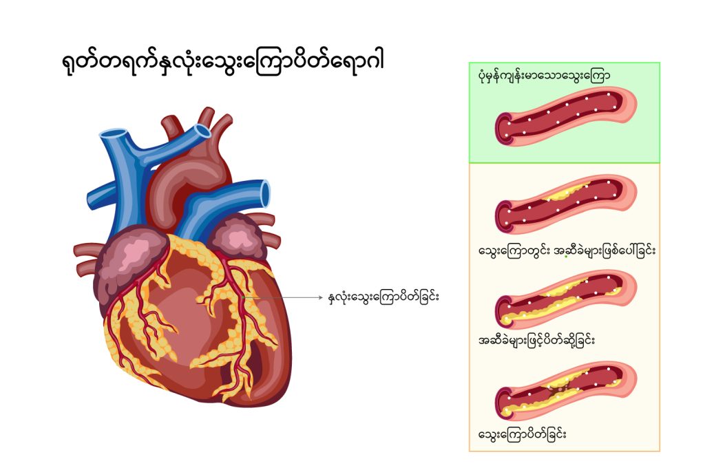 ACS img1