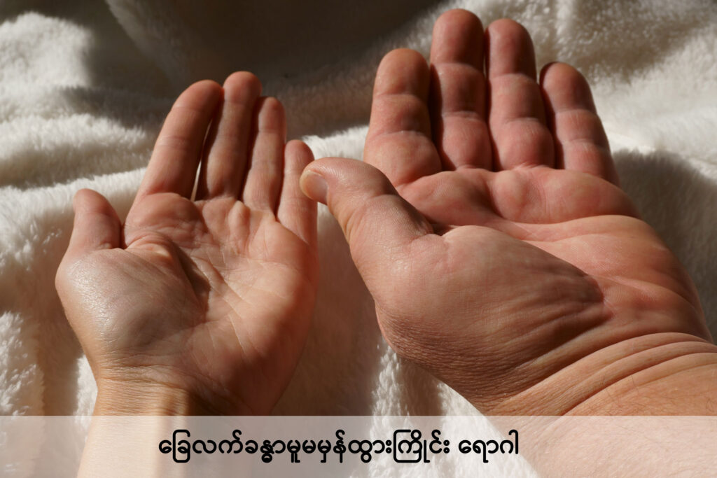Acromegaly img2