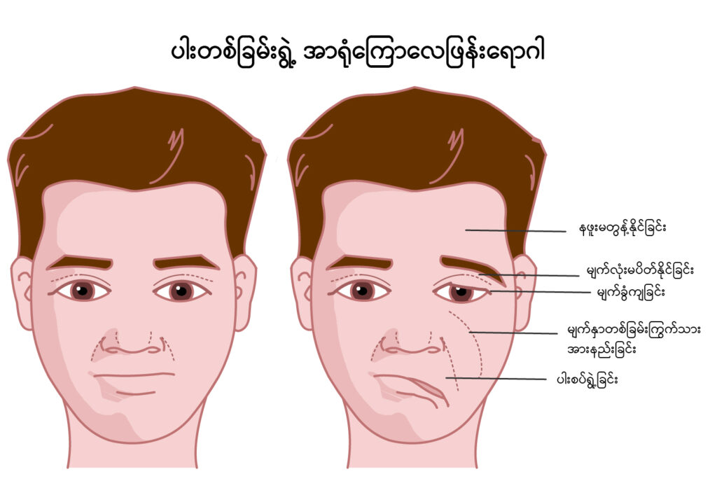 Bell's palsy img1