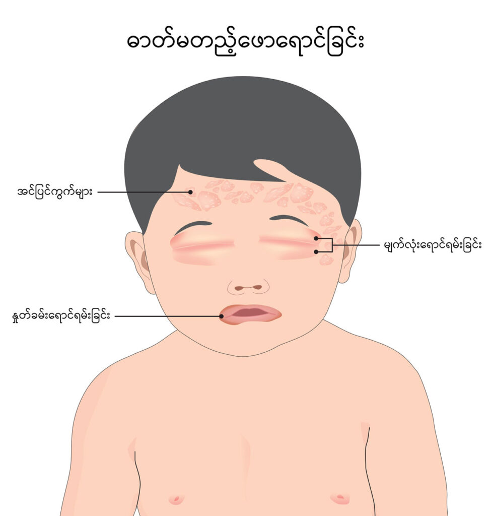 Angioedema img1
