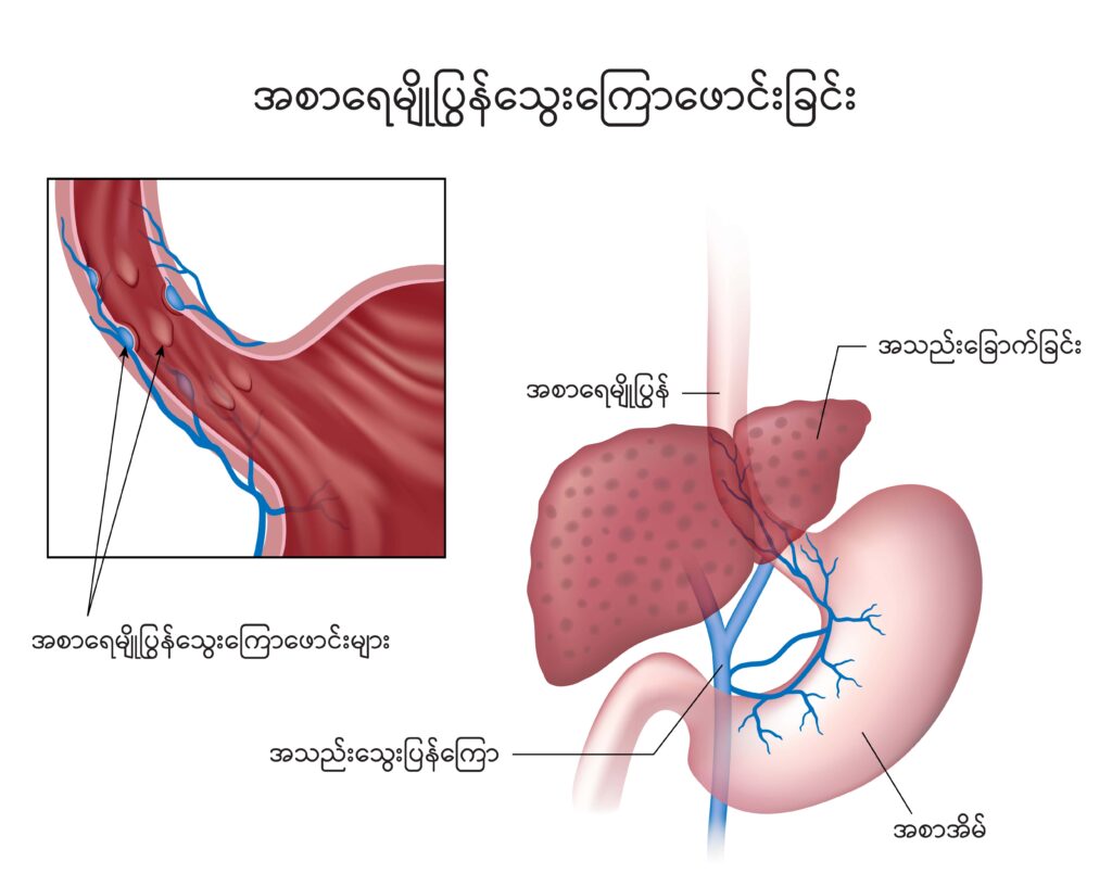 GI bleeding IMG1