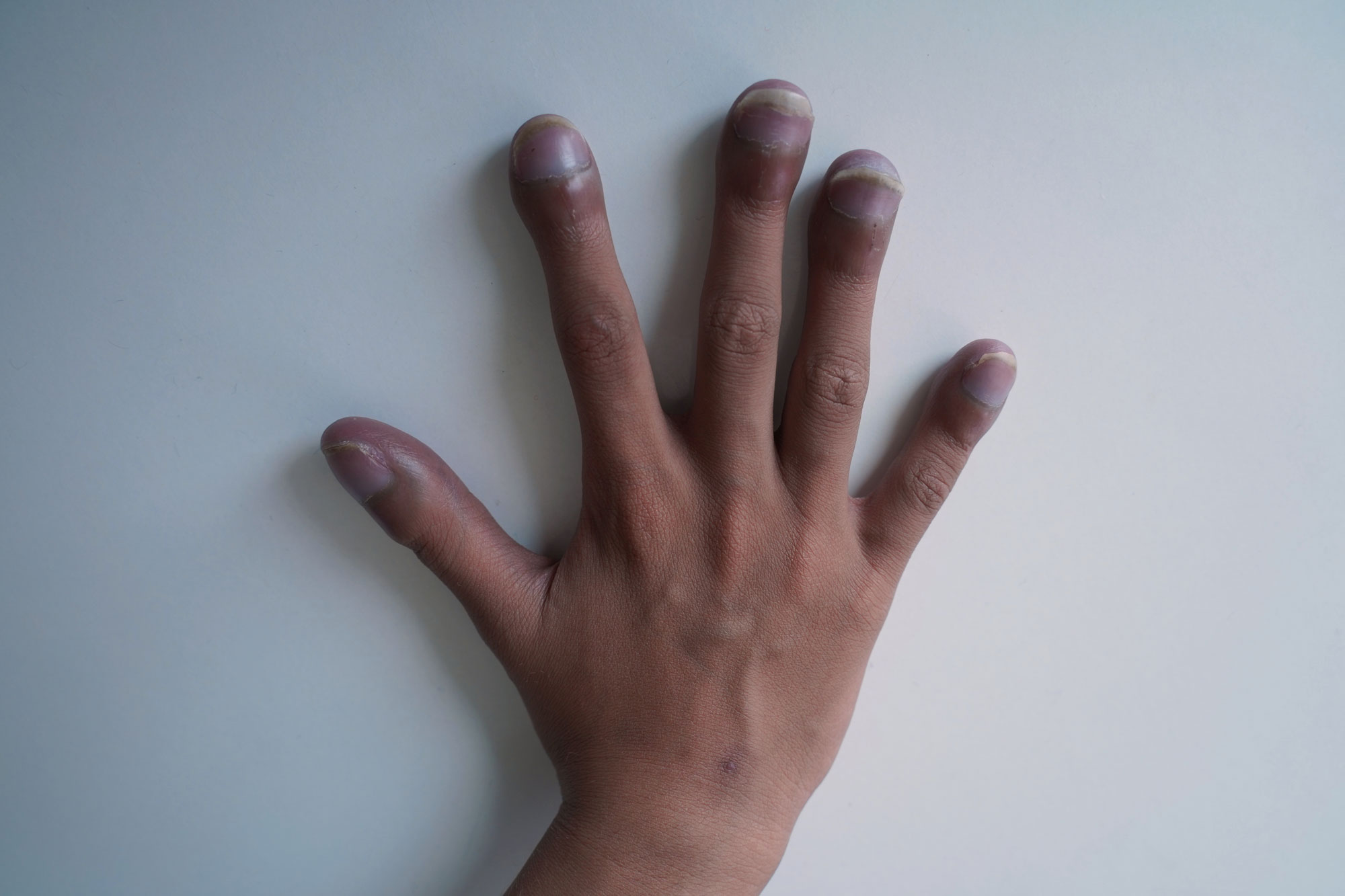 Cyanosis IMG1