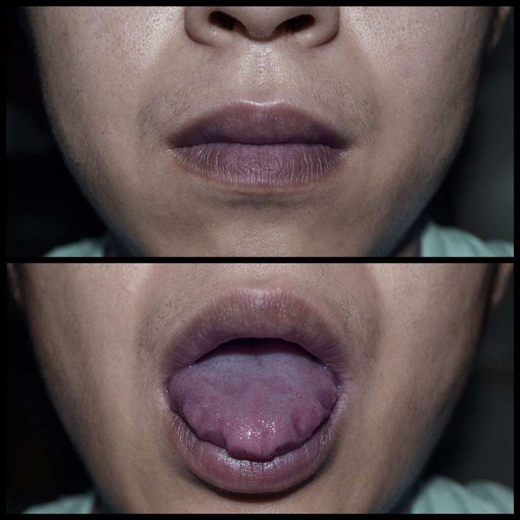 Cyanosis IMG3