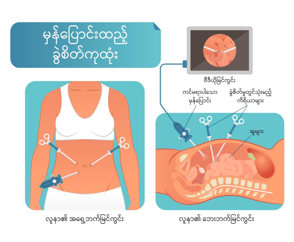 Minimally Invasive Surgery