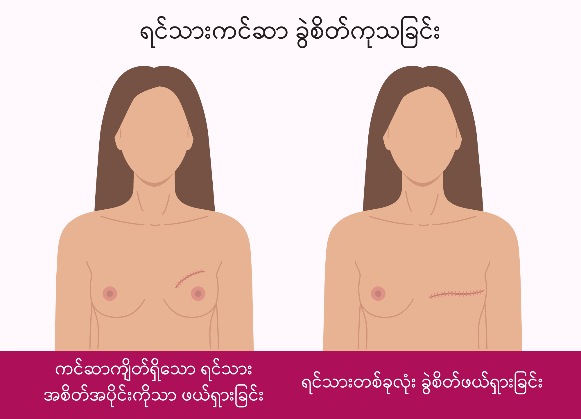 Breast Cancer Surgery IMG1