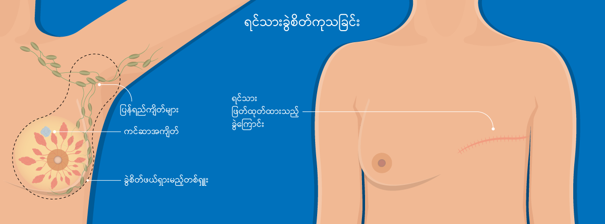 Breast Cancer Surgery IMG2