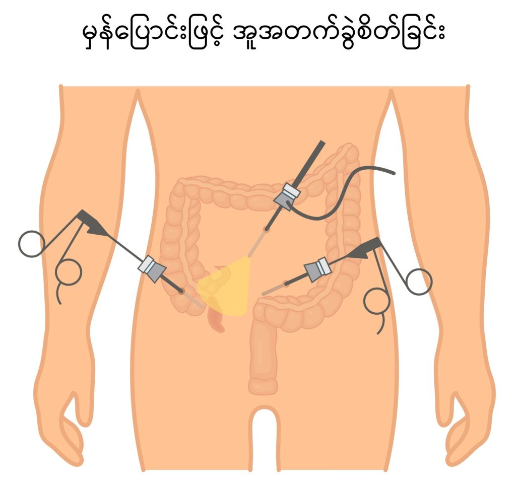Appendicectomy image