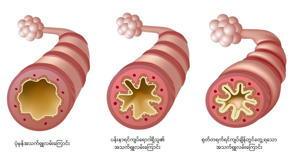 Asthma image