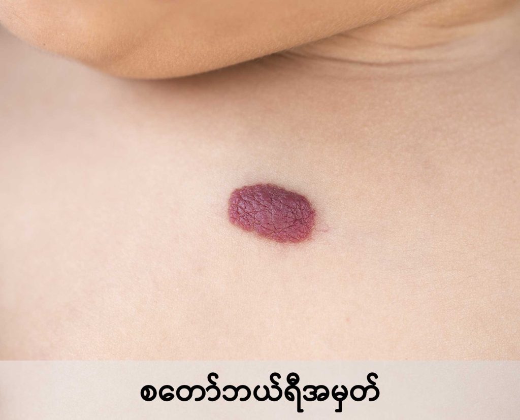 Birthmark image2