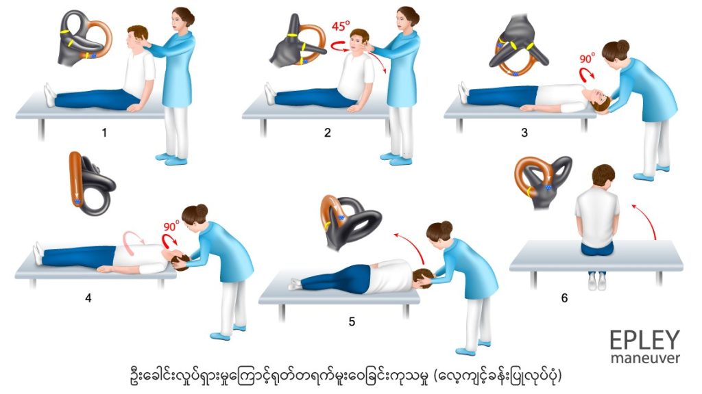BPPV image3