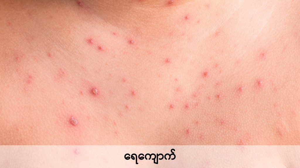 Chicken pox image1