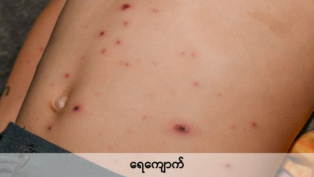 Chicken pox image2