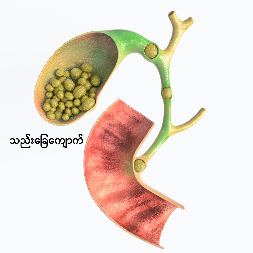 Cholecystectomy image