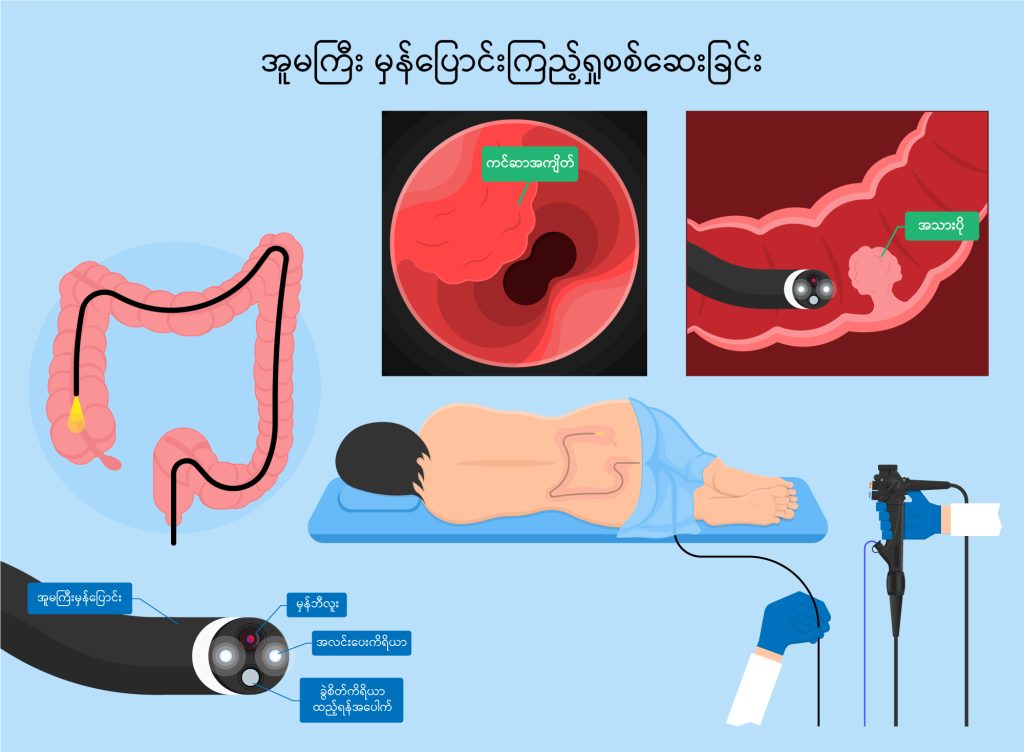 Colonoscopy image
